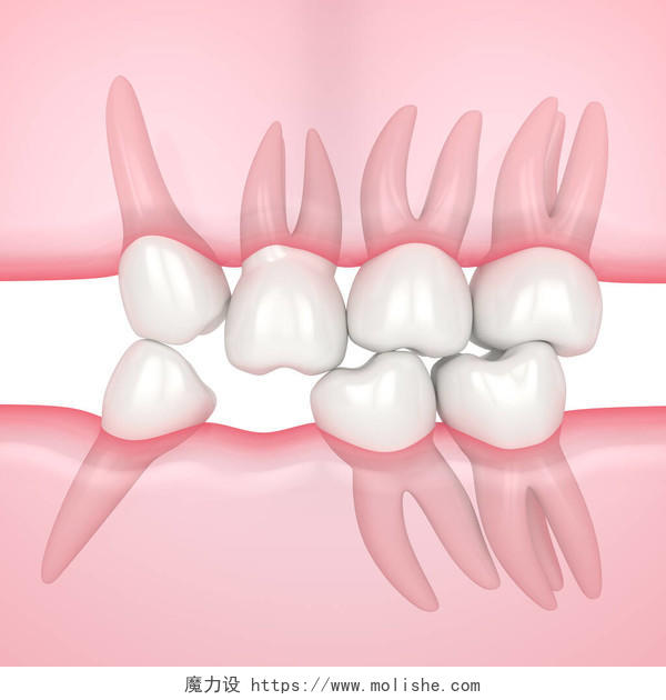 三维渲染的牙齿滑向缺牙区域以填补缺口